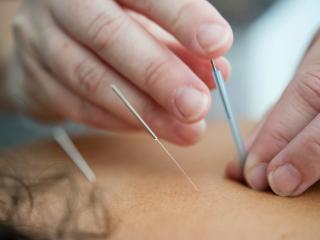 Acupuncture Rotorua